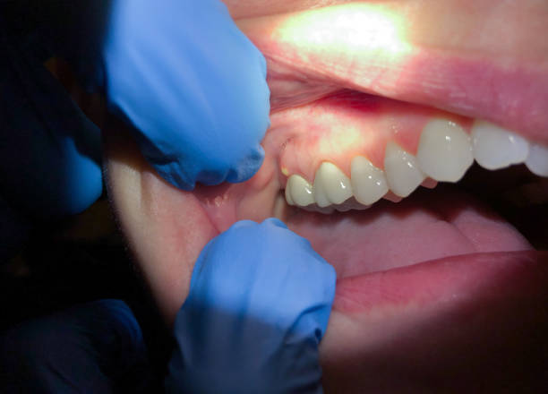 Best Emergency Dental Care for Abscessed Tooth in Bensley, VA